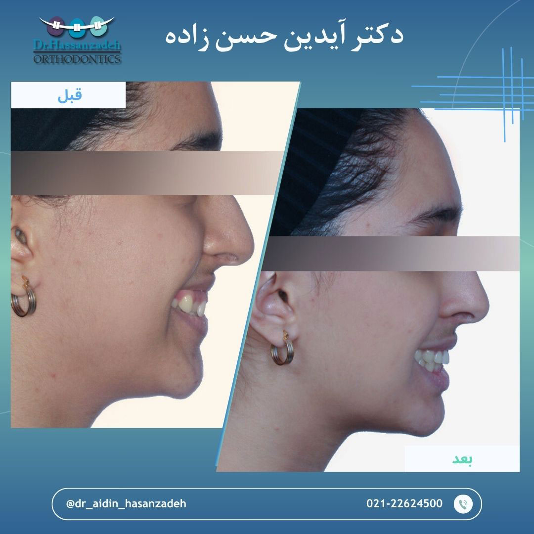 قبل و بعد از درمان اورتودنسی
