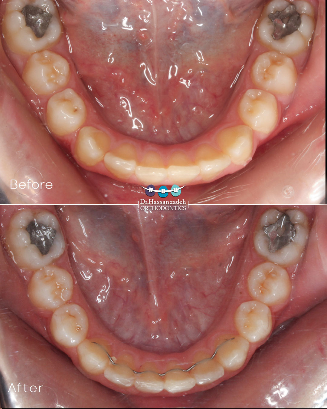 قبل و بعد از درمان اورتودنسی