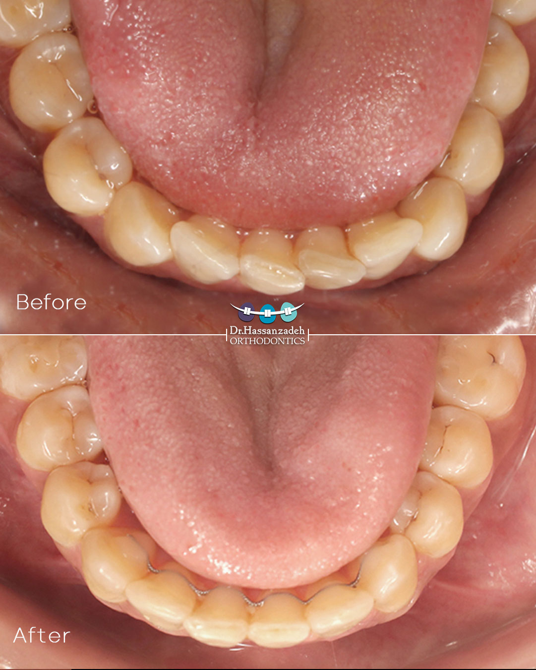 قبل و بعد از درمان اورتودنسی