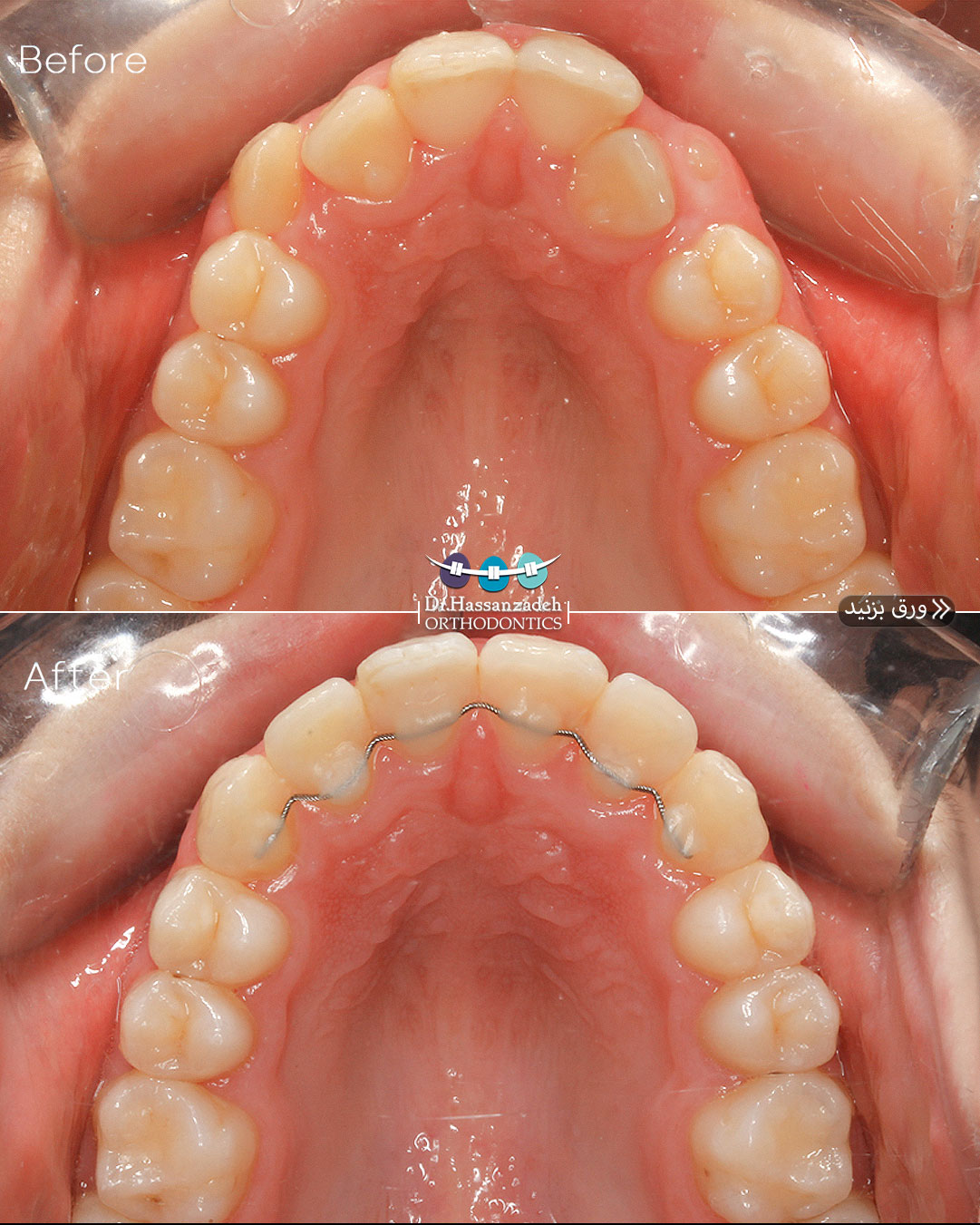 قبل و بعد از درمان اورتودنسی