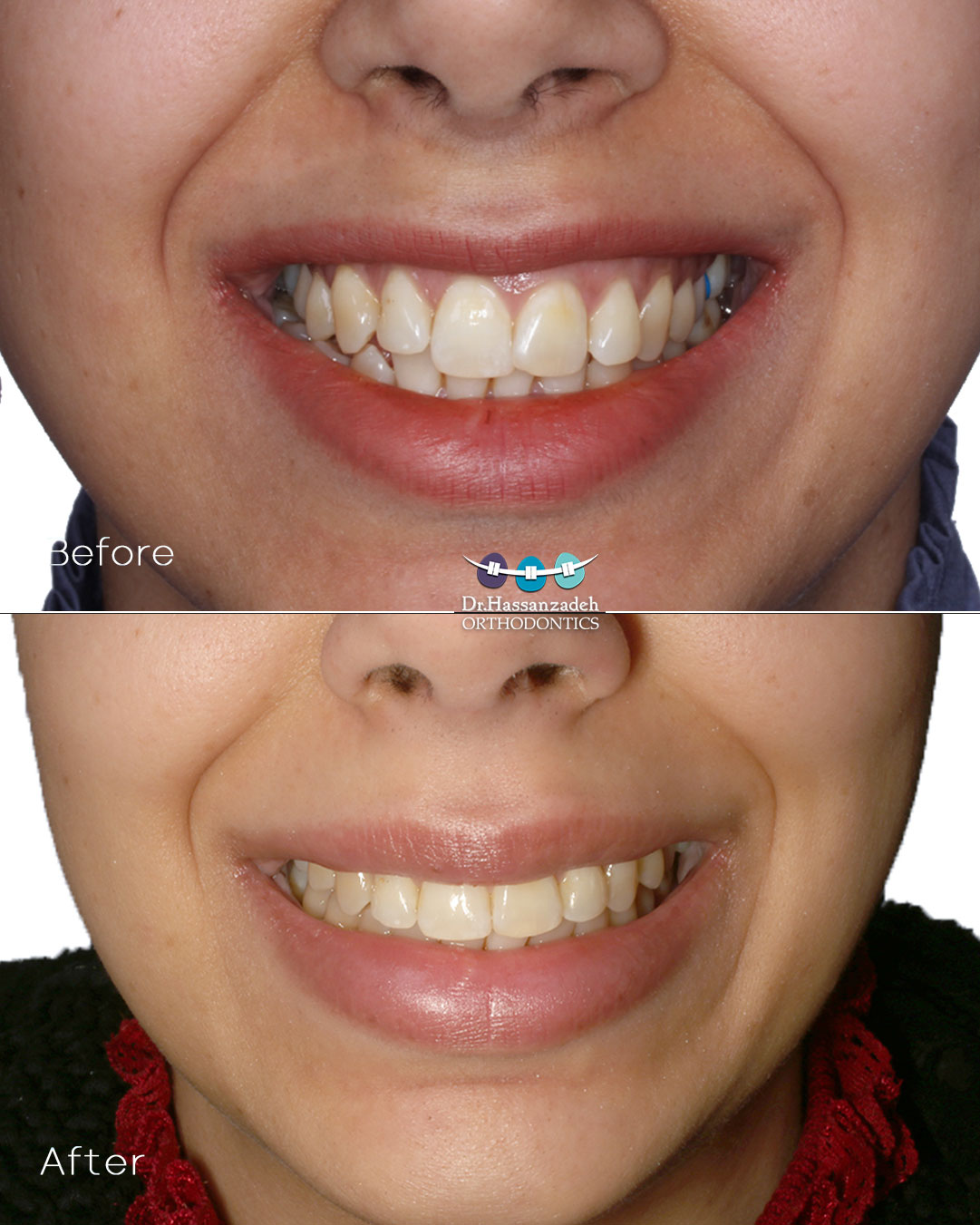 قبل و بعد از درمان اورتودنسی