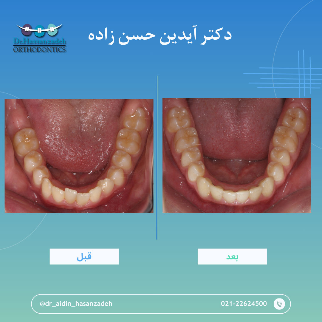 قبل و بعد از درمان اورتودنسی