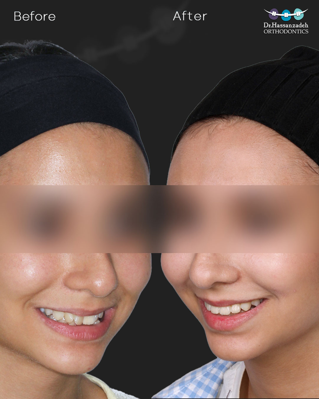 قبل و بعد از درمان اورتودنسی