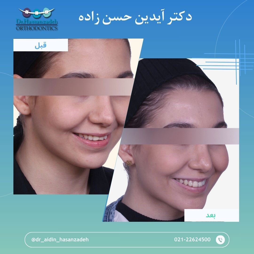 قبل و بعد از درمان اورتودنسی