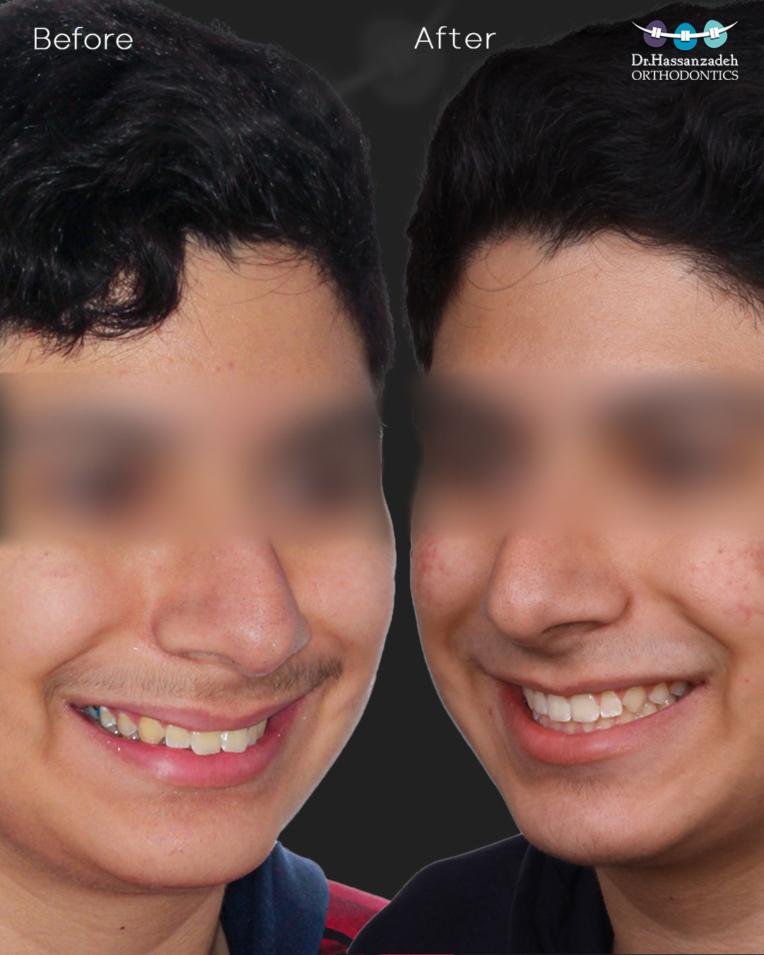 قبل و بعد از درمان اورتودنسی