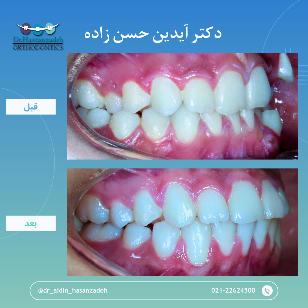 قبل و بعد از درمان اورتودنسی