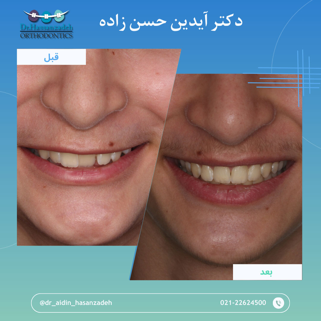 قبل و بعد از درمان