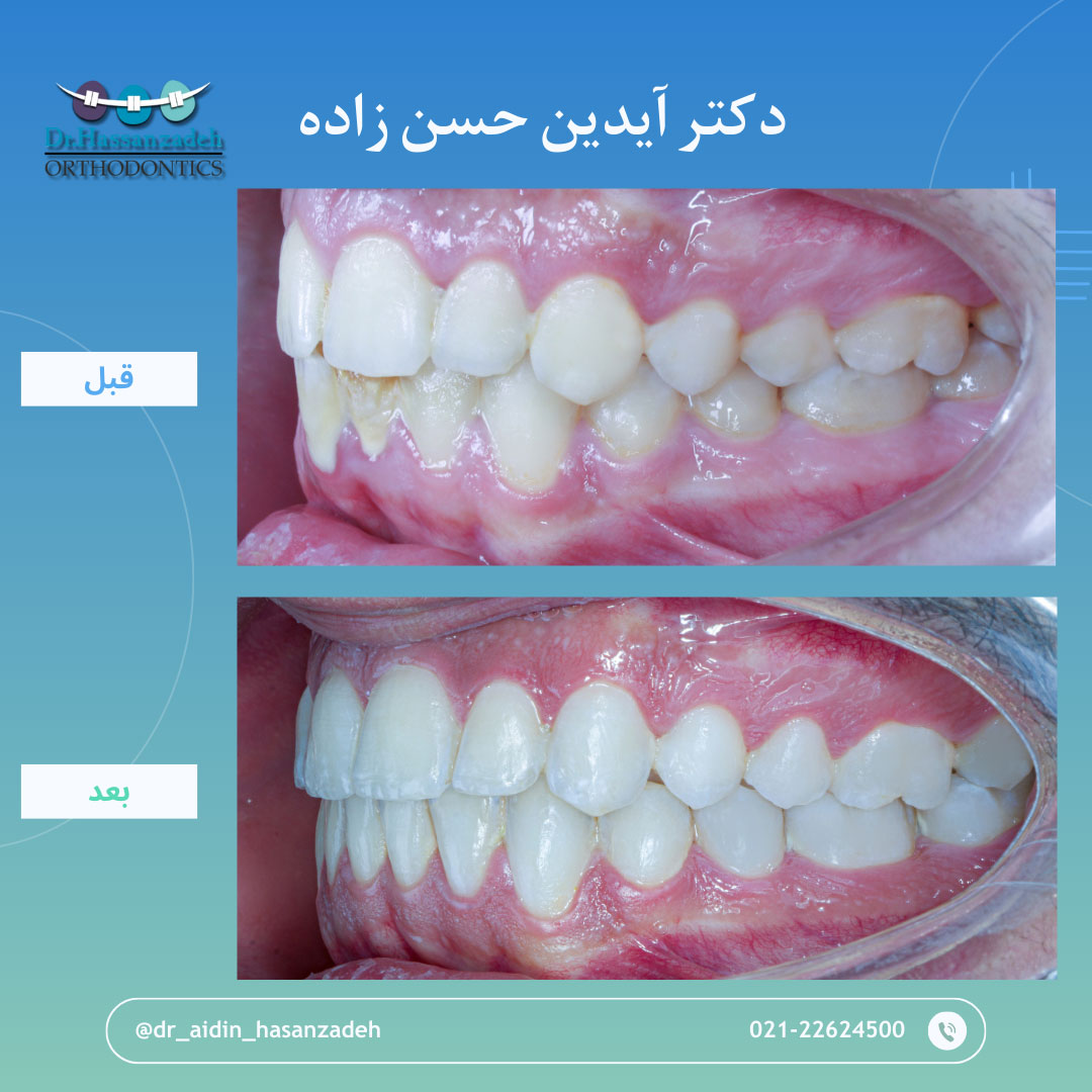 قبل و بعد از درمان اورتودنسی