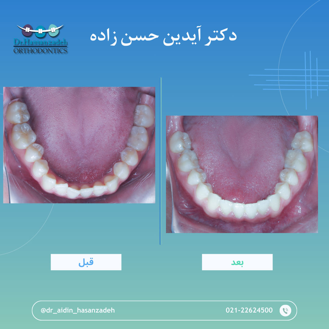 قبل و بعد از درمان اورتودنسی