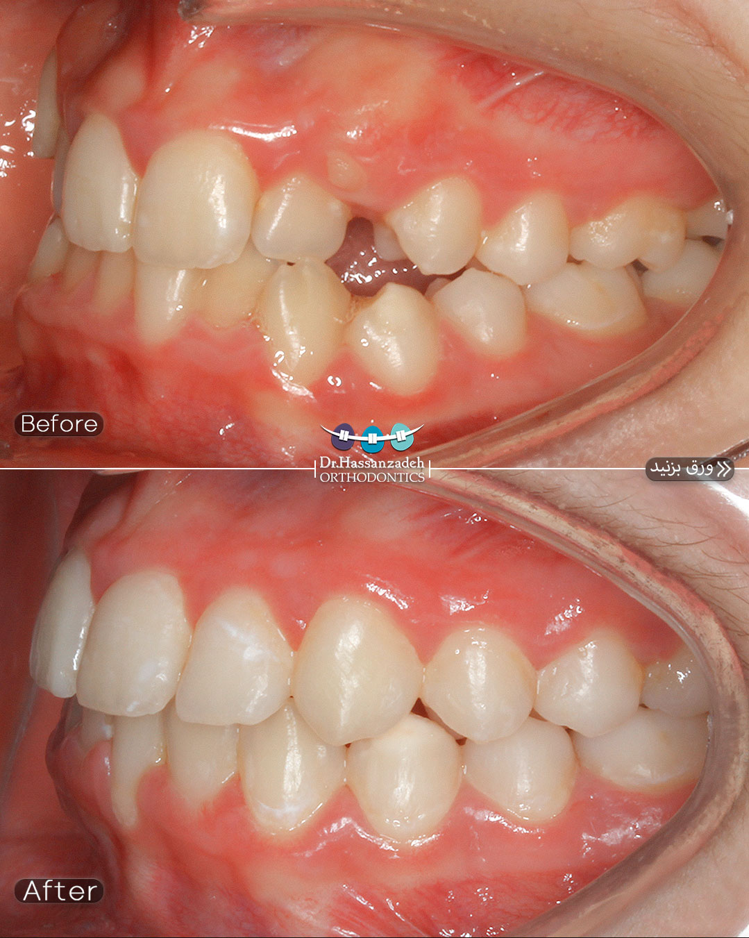 قبل و بعد از درمان اورتودنسی