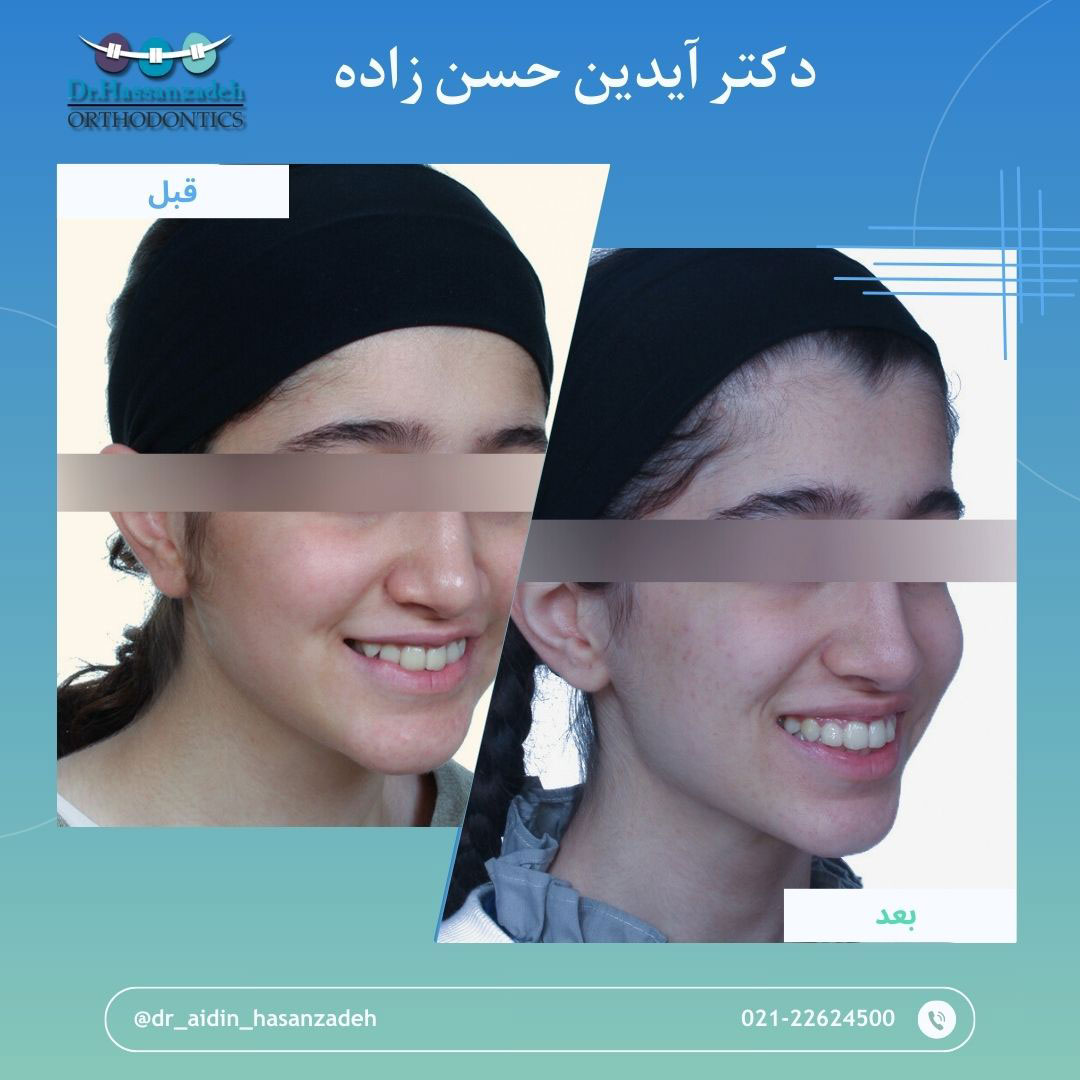 قبل و بعد از درمان اورتودنسی
