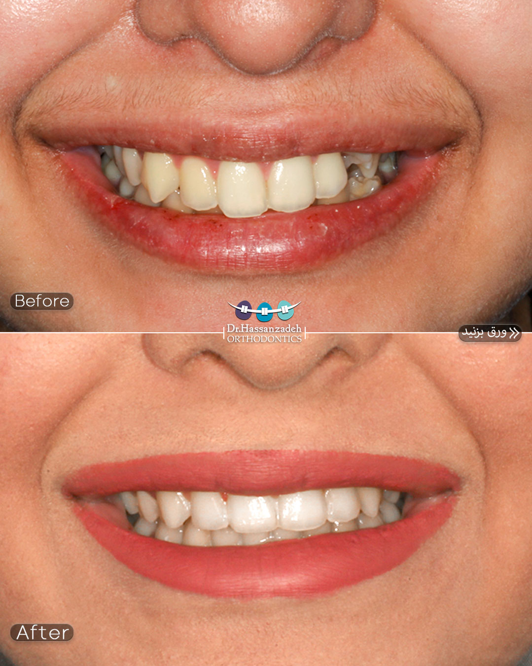 قبل و بعد از درمان اورتودنسی