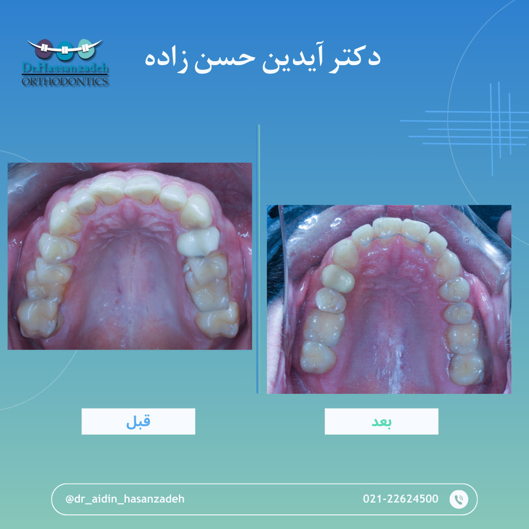 قبل و بعد از درمان اورتودنسی