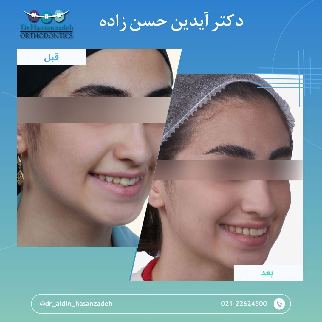 قبل و بعد از درمان اورتودنسی