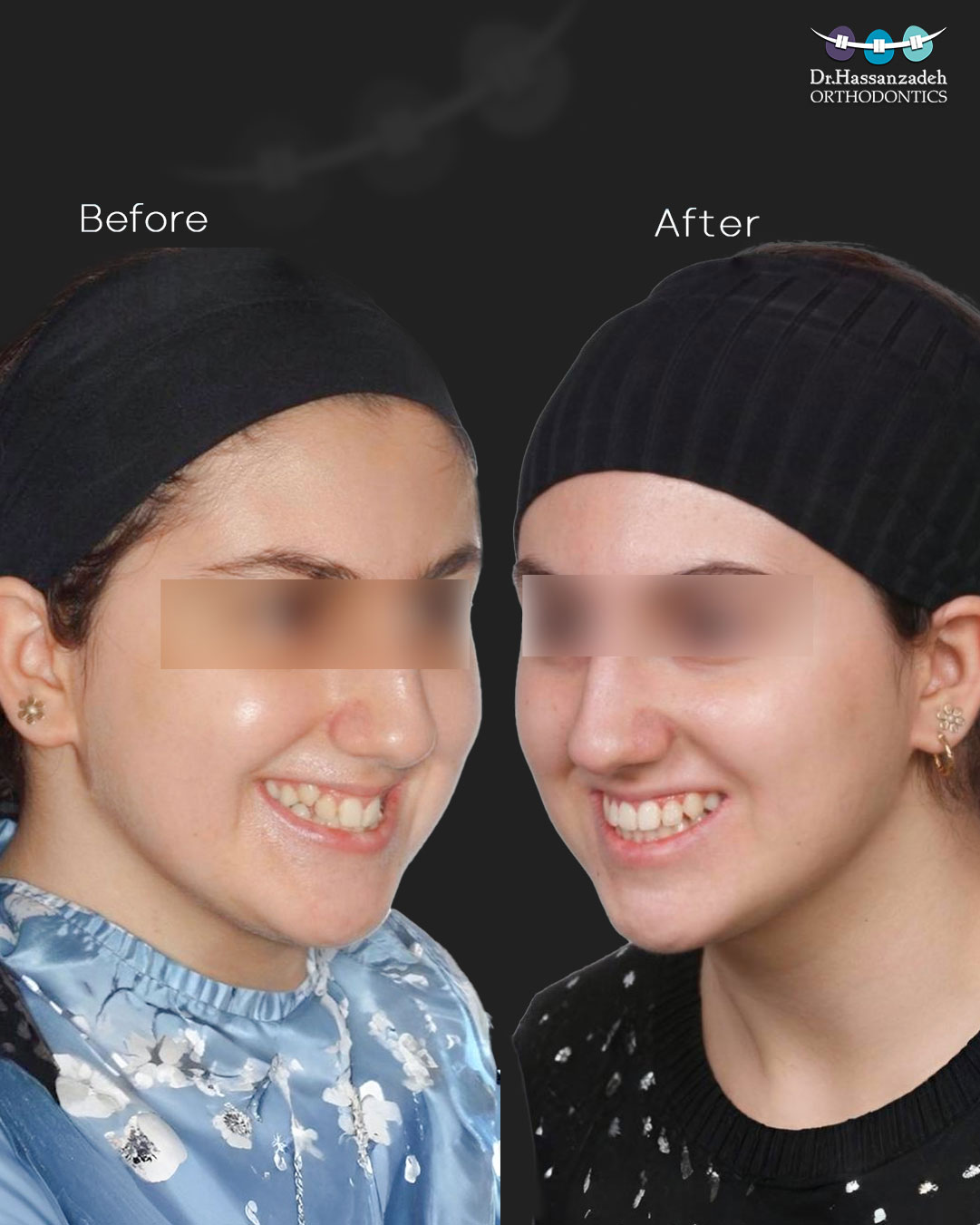 قبل و بعد از درمان اورتودنسی