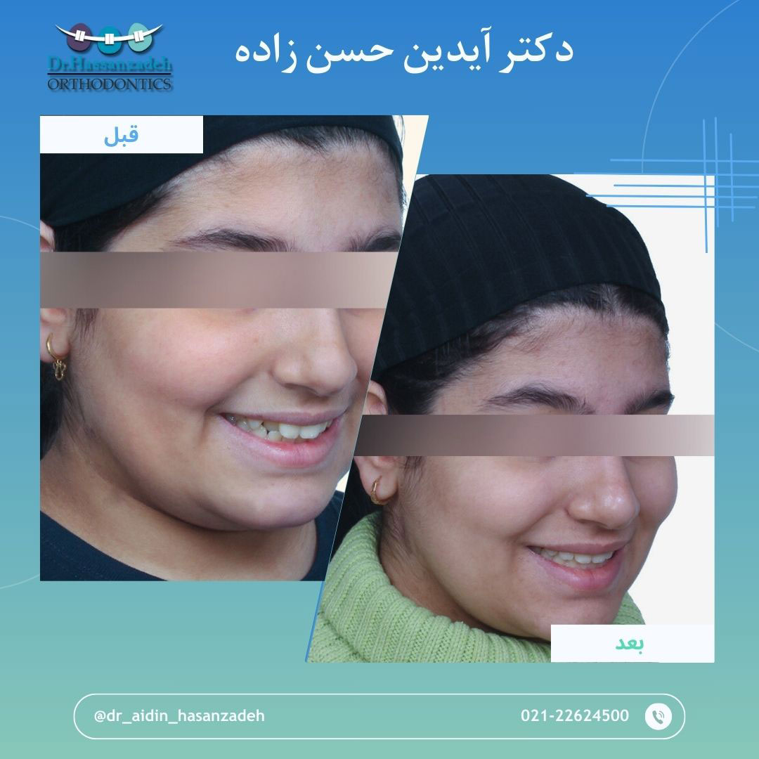 قبل و بعد از درمان اورتودنسی