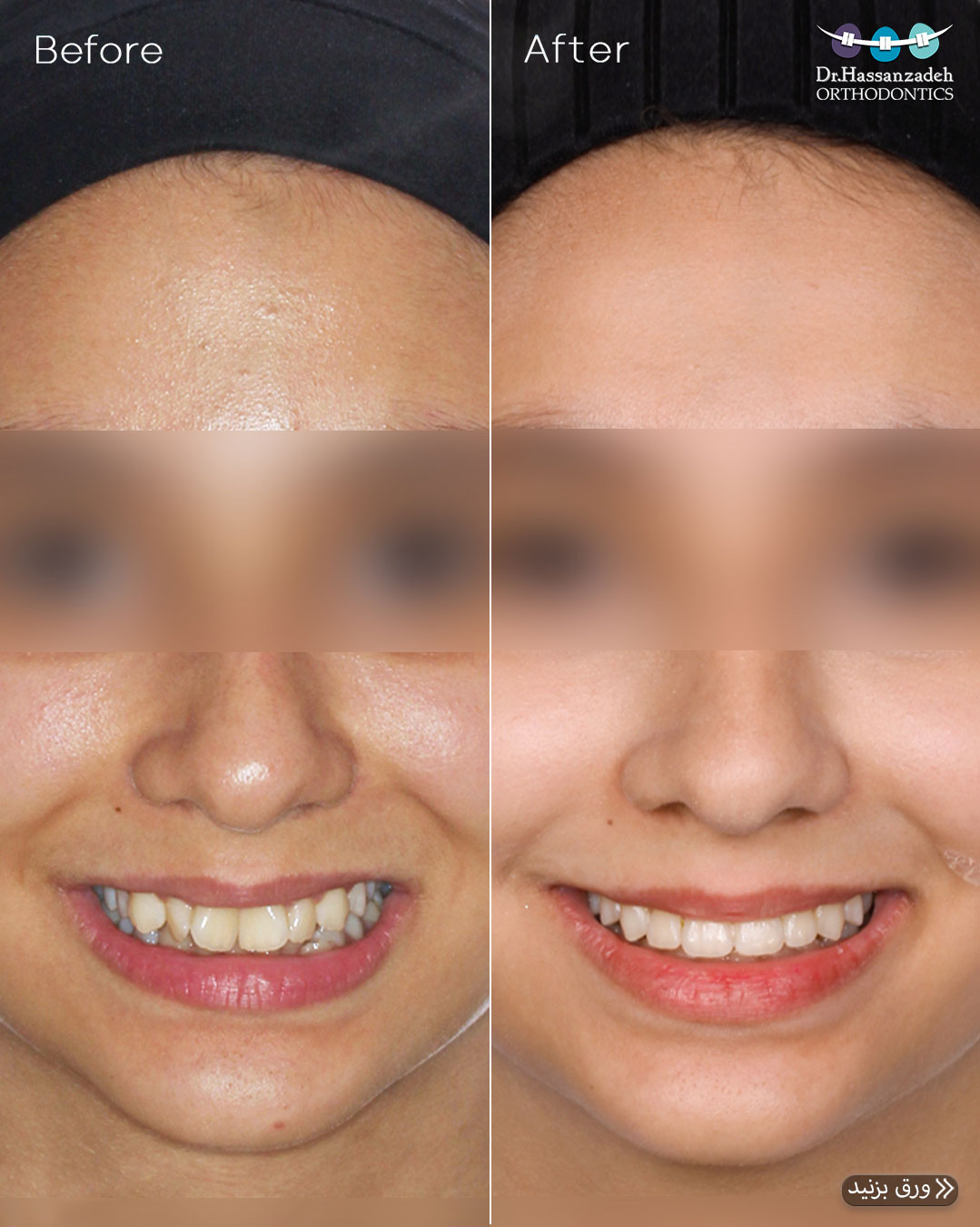 قبل و بعد از درمان