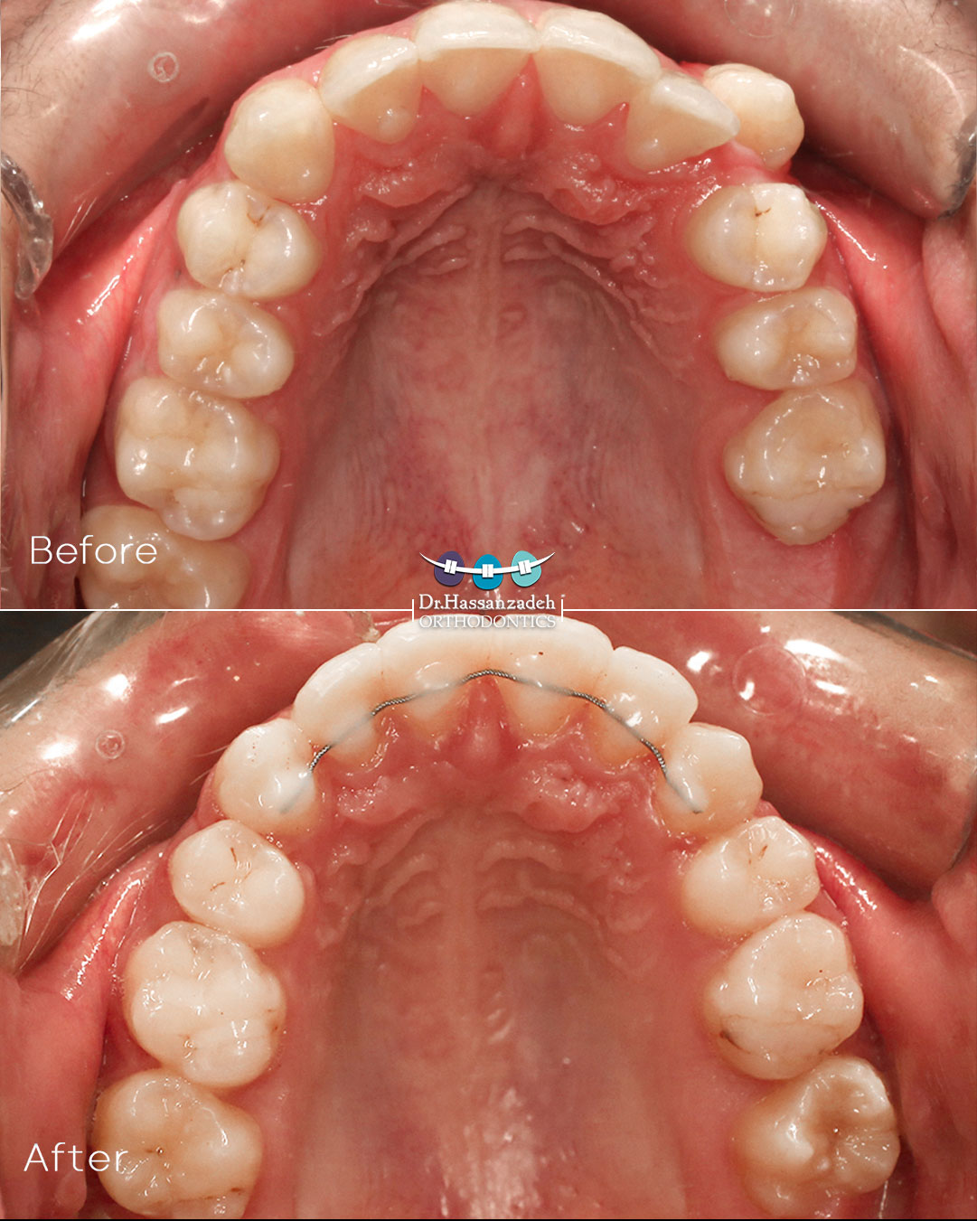 قبل و بعد از درمان اورتودنسی