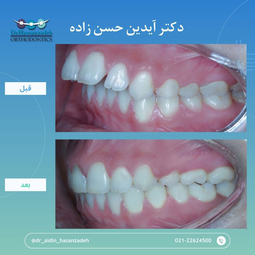 قبل و بعد از درمان اورتودنسی