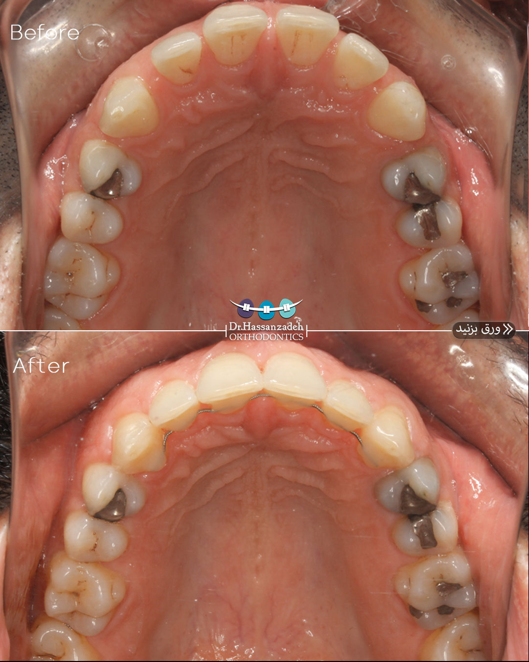 قبل و بعد از درمان اورتودنسی