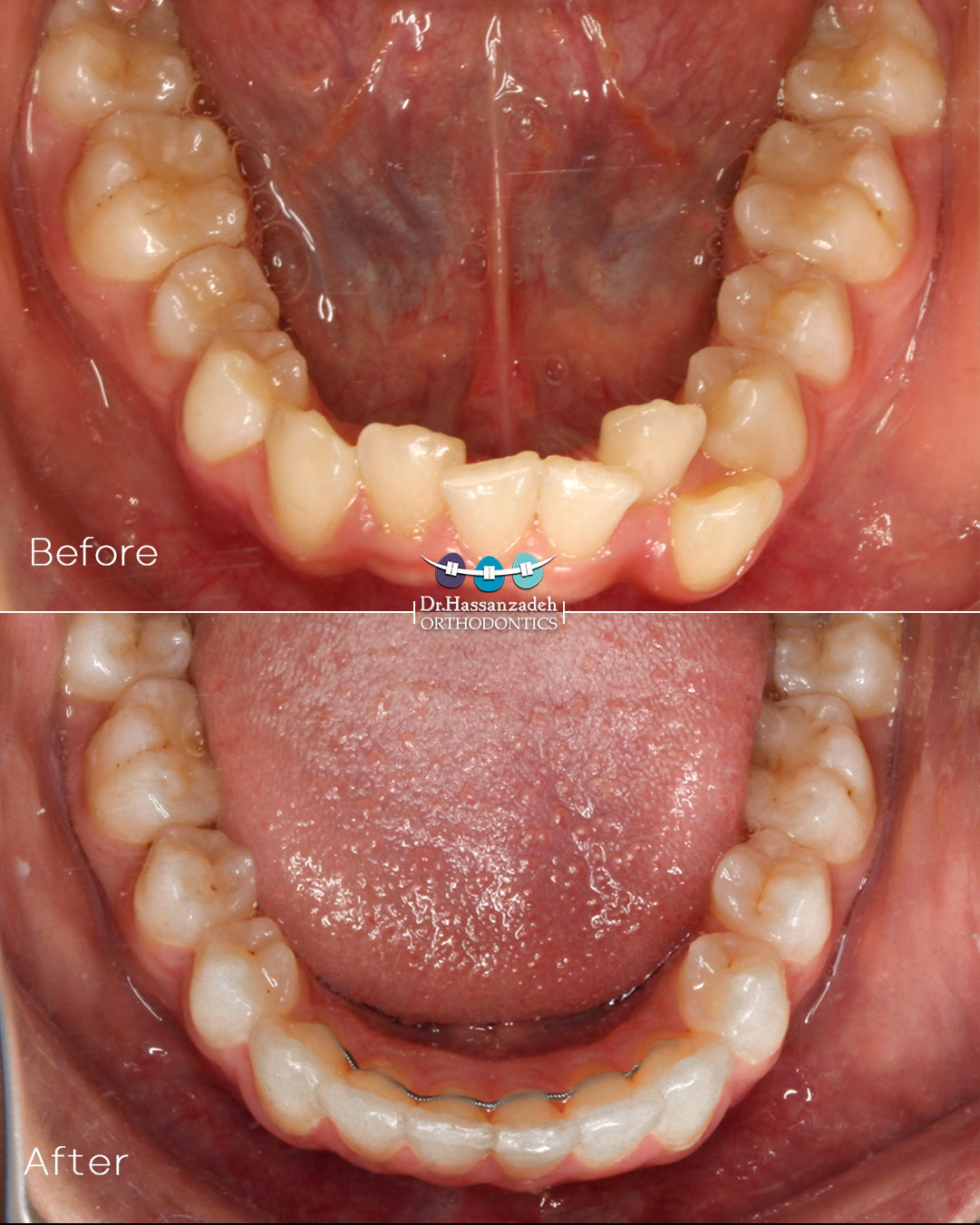 قبل و بعد از درمان اورتودنسی