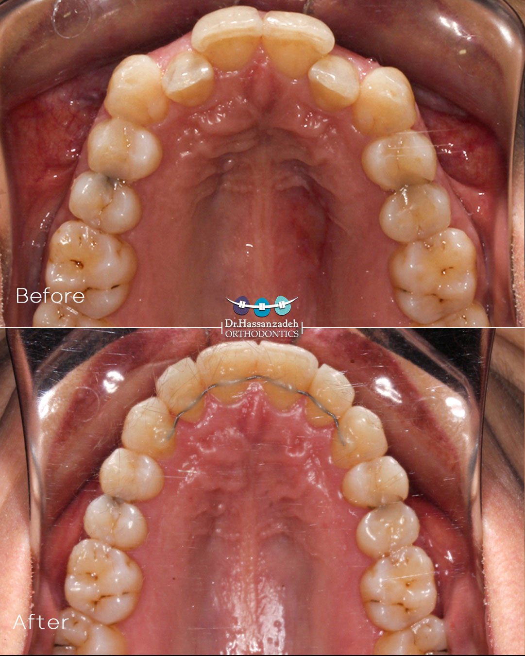 قبل و بعد از درمان اورتودنسی