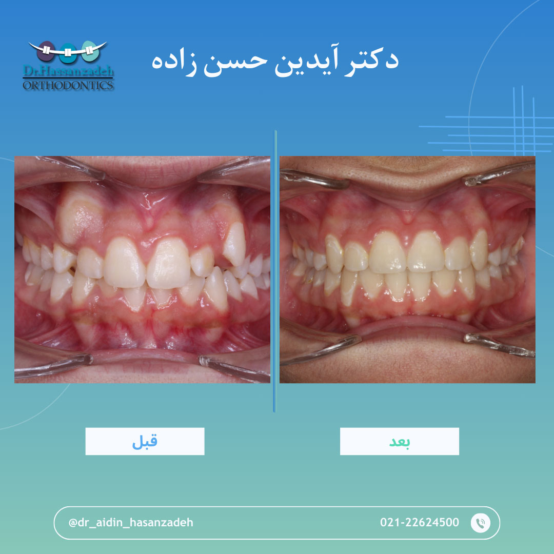 قبل و بعد از درمان اورتودنسی