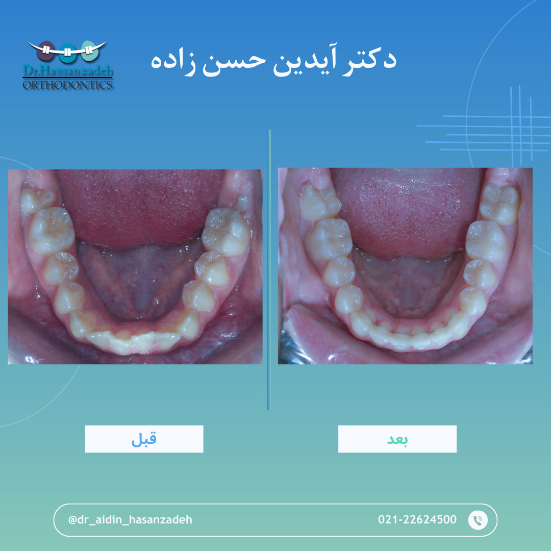 قبل و بعد از درمان اورتودنسی