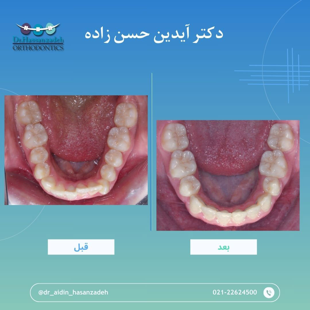 قبل و بعد از درمان اورتودنسی