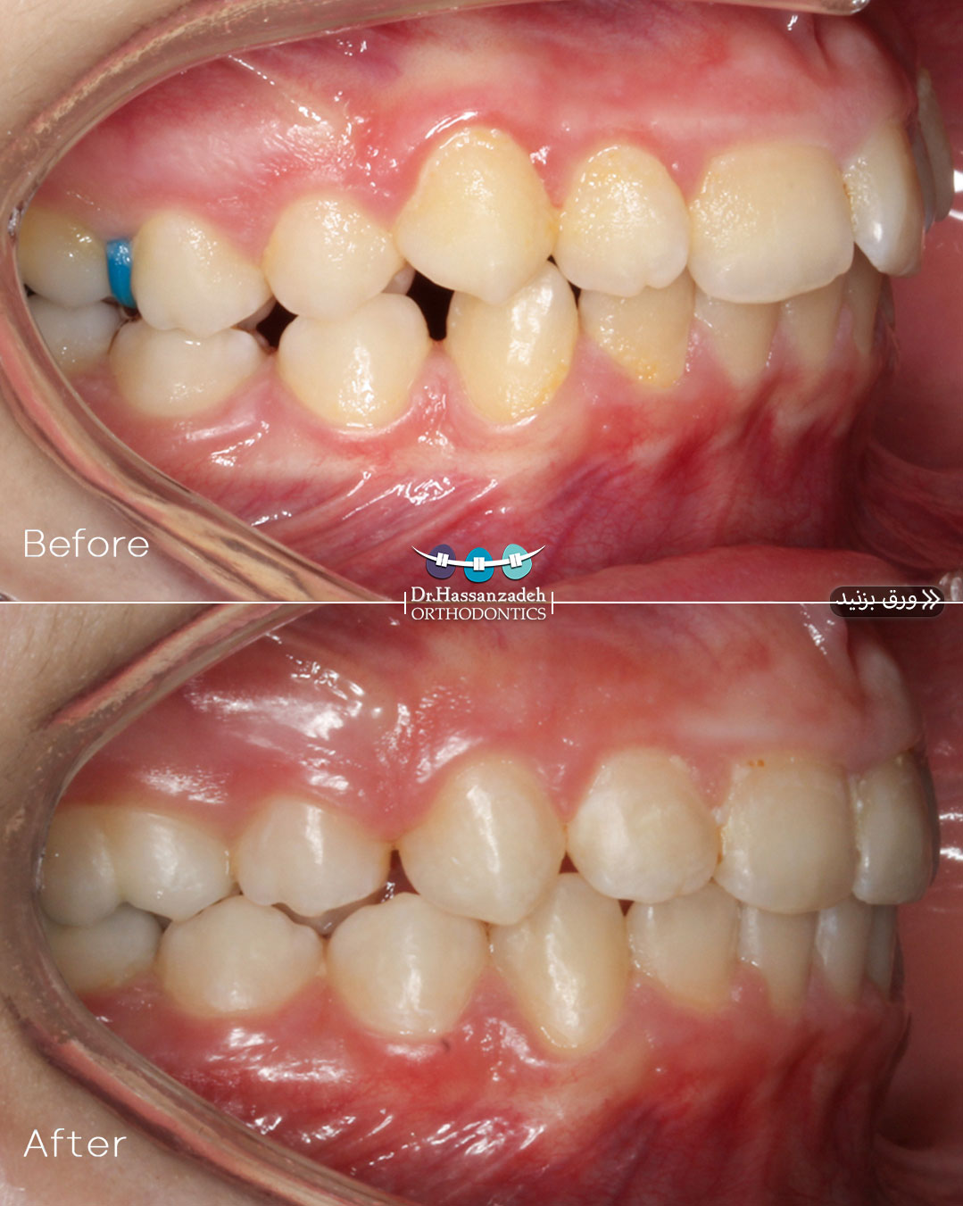 قبل و بعد از درمان اورتودنسی