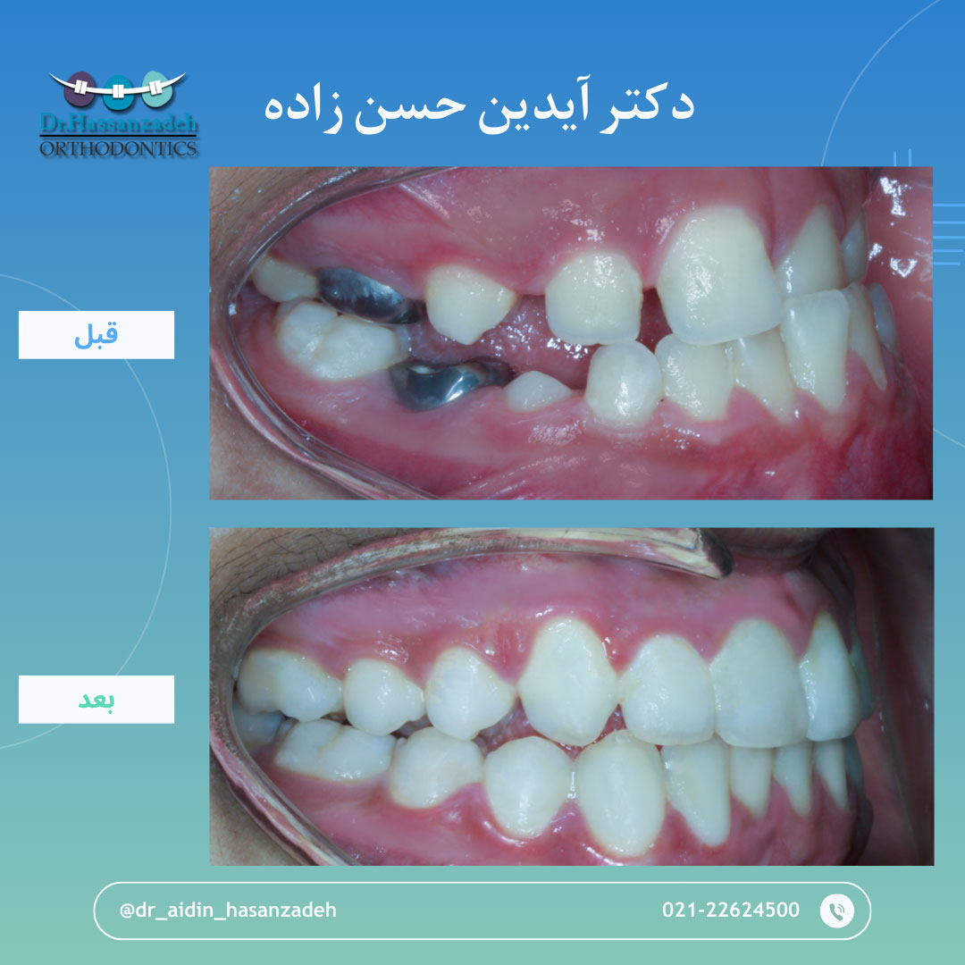 قبل و بعد از درمان اورتودنسی