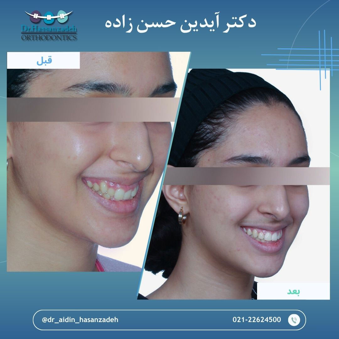 قبل و بعد از درمان اورتودنسی