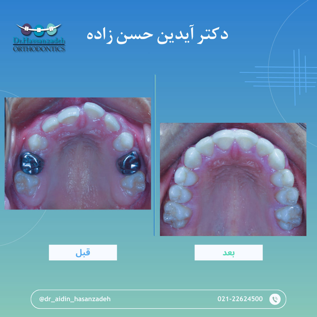 قبل و بعد از درمان اورتودنسی