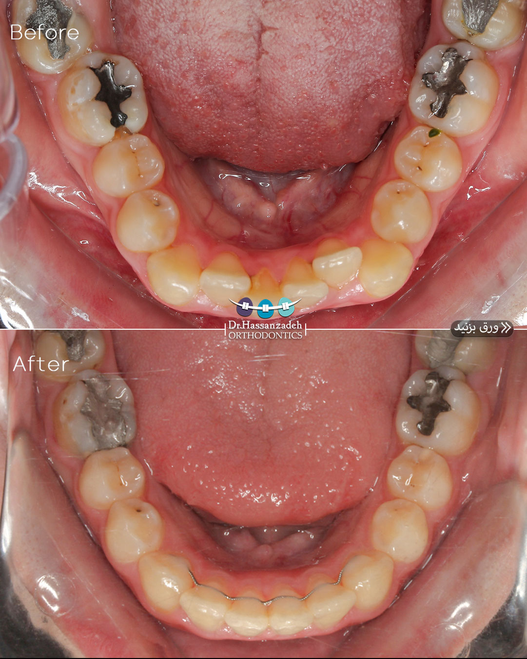 قبل و بعد از درمان اورتودنسی