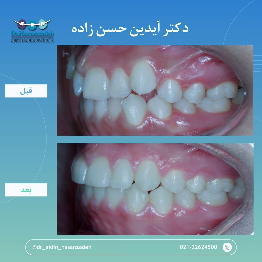 قبل و بعد از درمان اورتودنسی