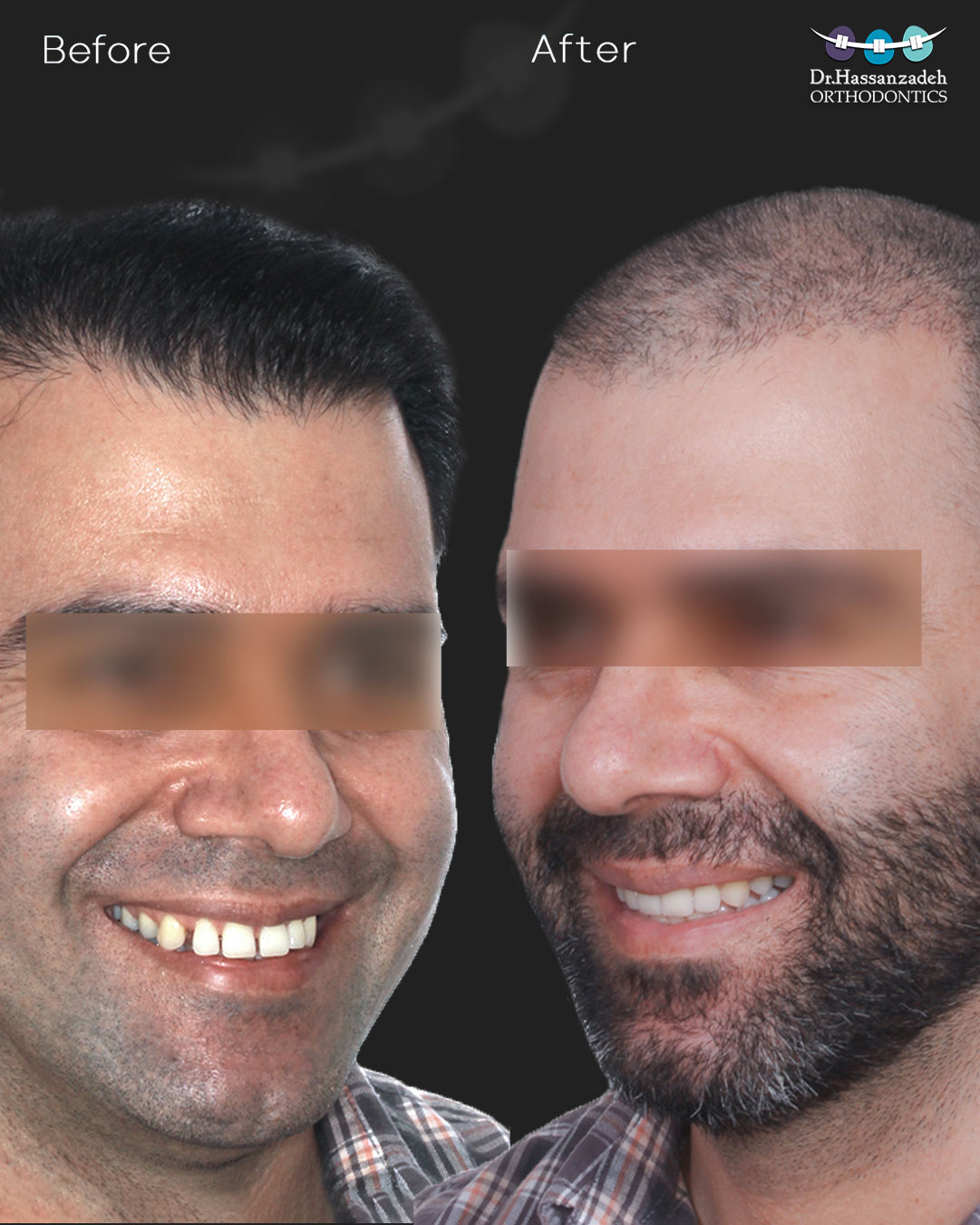 قبل و بعد از درمان اورتودنسی