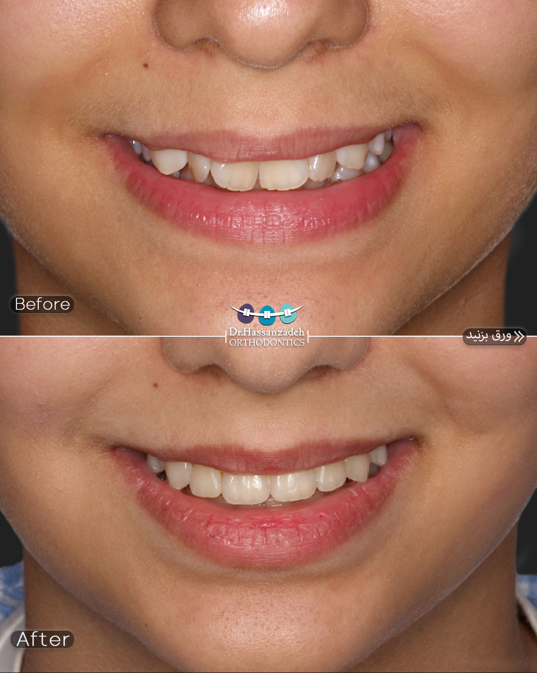 قبل و بعد از درمان اورتودنسی