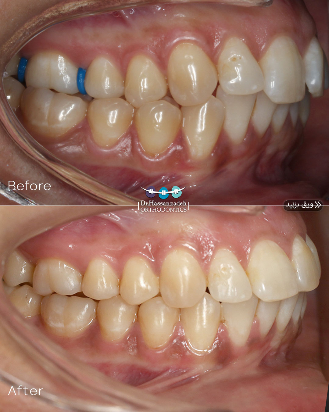 قبل و بعد از درمان اورتودنسی