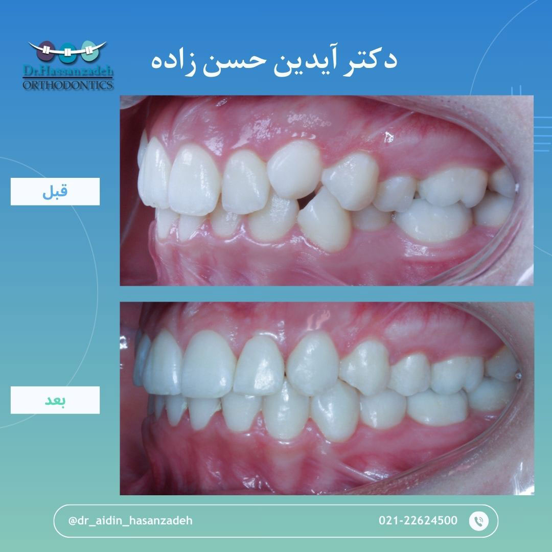 قبل و بعد از درمان اورتودنسی