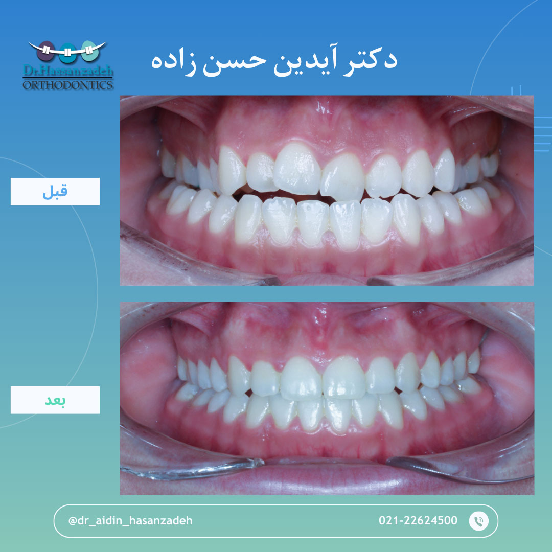 قبل و بعد از درمان اورتودنسی