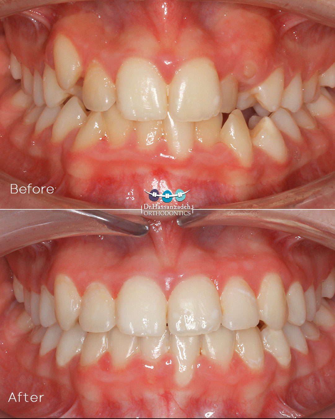 قبل و بعد از درمان اورتودنسی