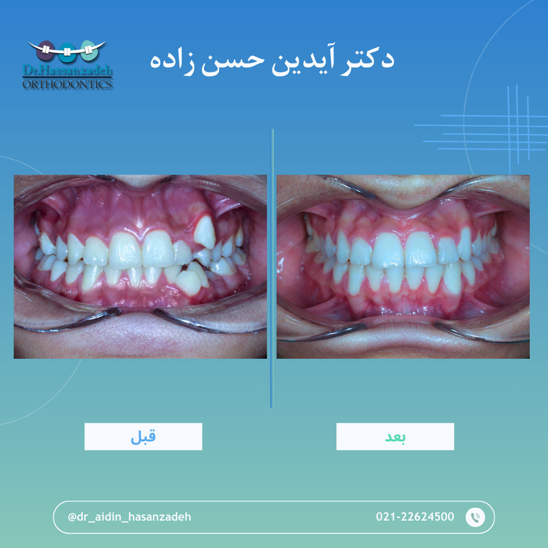 قبل و بعد از درمان اورتودنسی