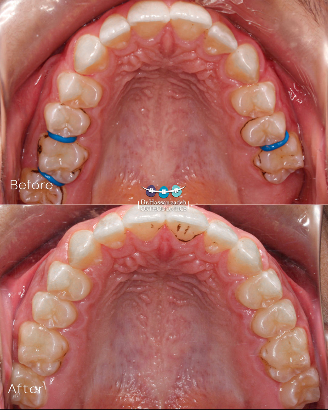 قبل و بعد از درمان اورتودنسی