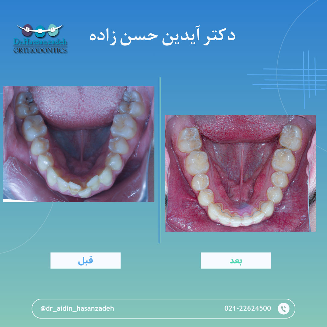قبل و بعد از درمان اورتودنسی