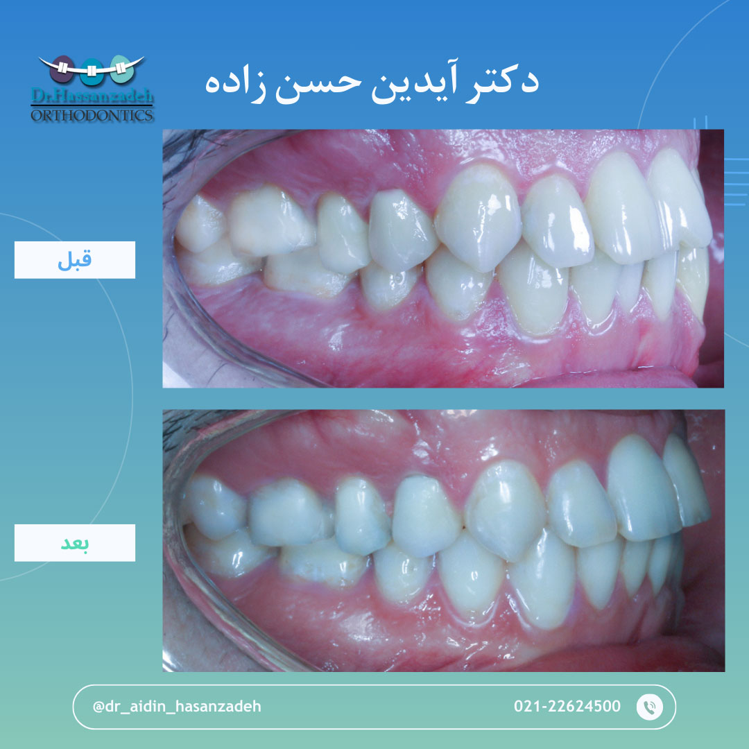 قبل و بعد از درمان اورتودنسی