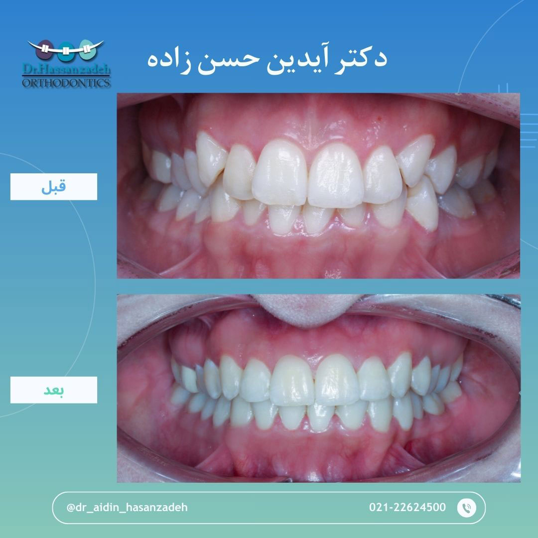 قبل و بعد از درمان اورتودنسی