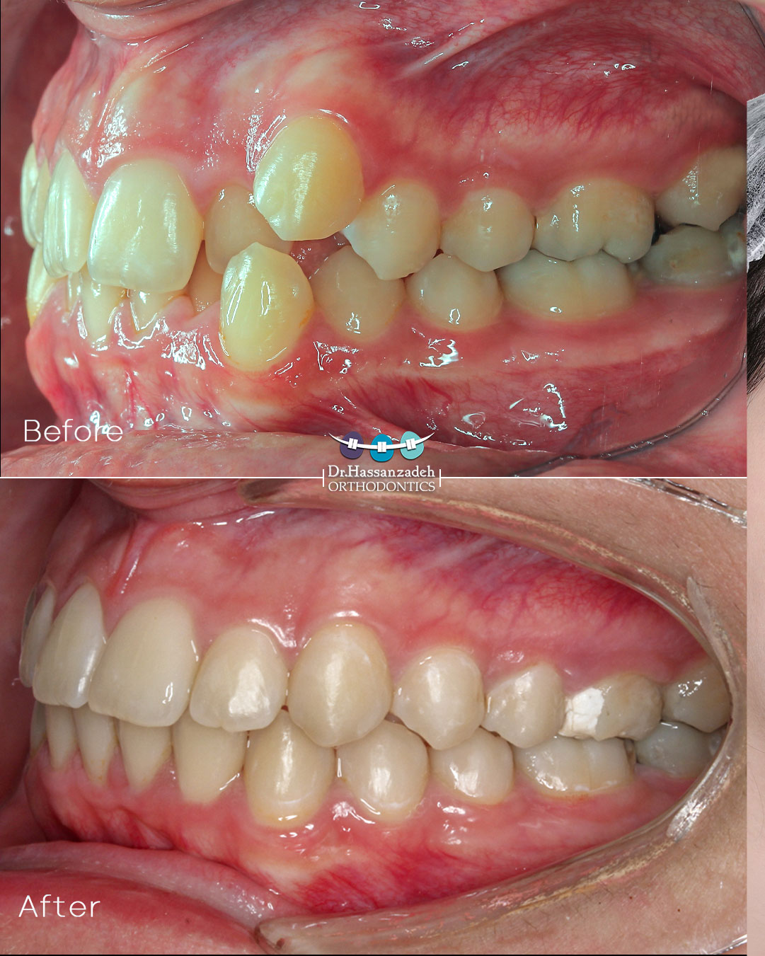 قبل و بعد از درمان اورتودنسی