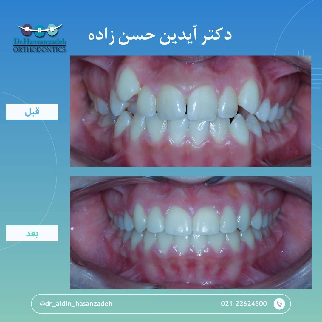 قبل و بعد از درمان اورتودنسی
