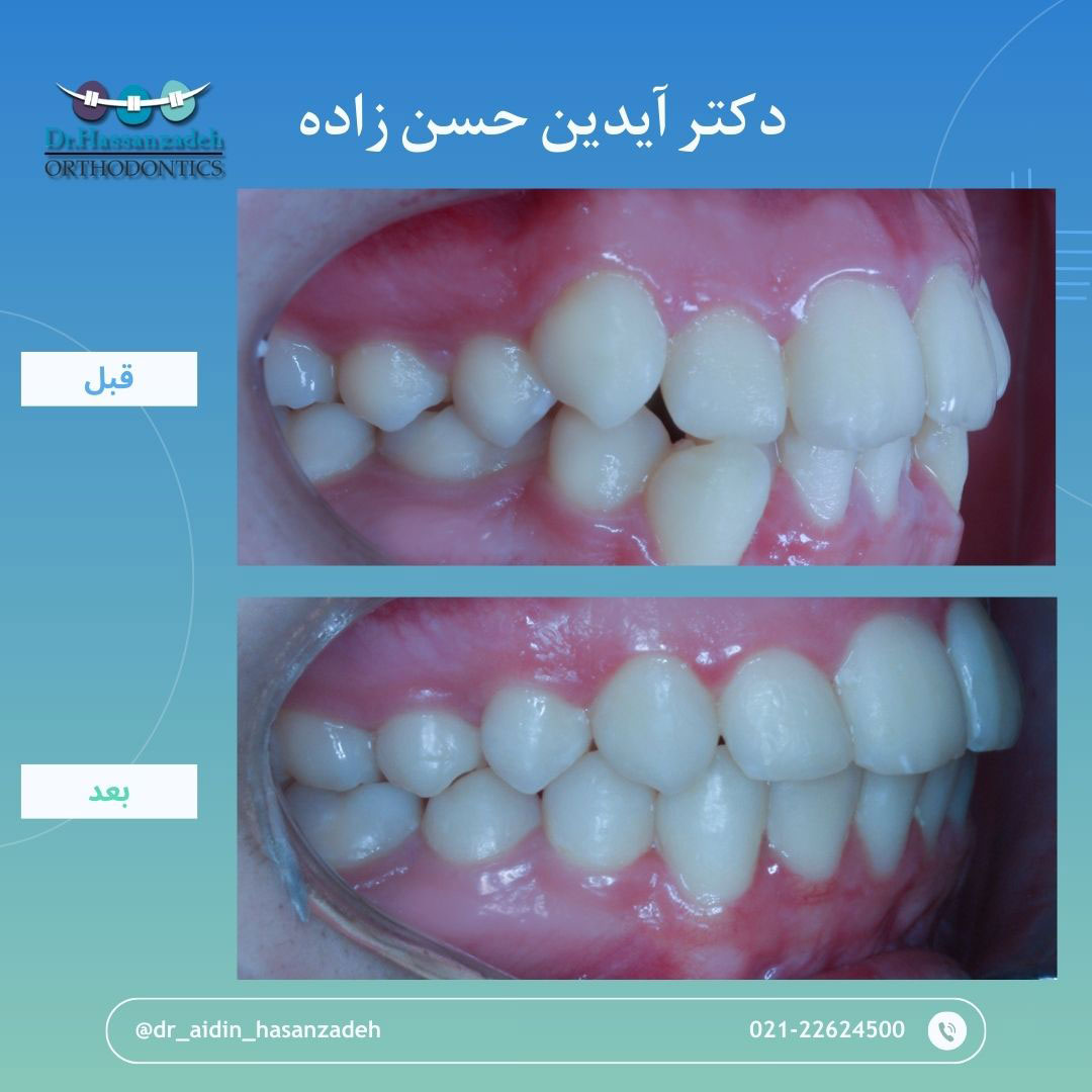 قبل و بعد از درمان اورتودنسی