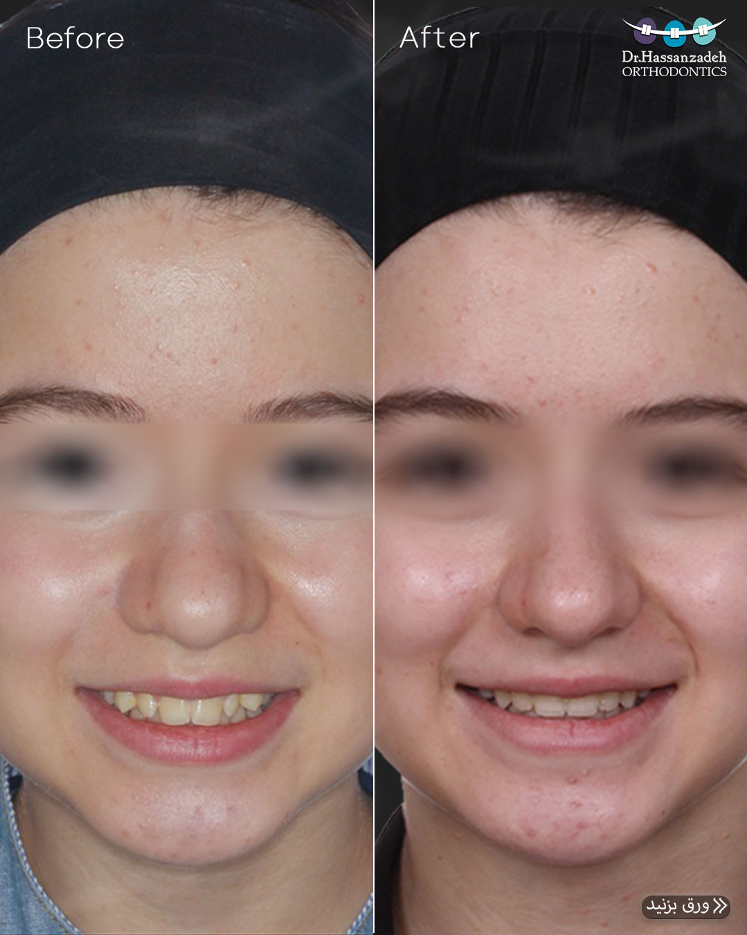 قبل و بعد از درمان